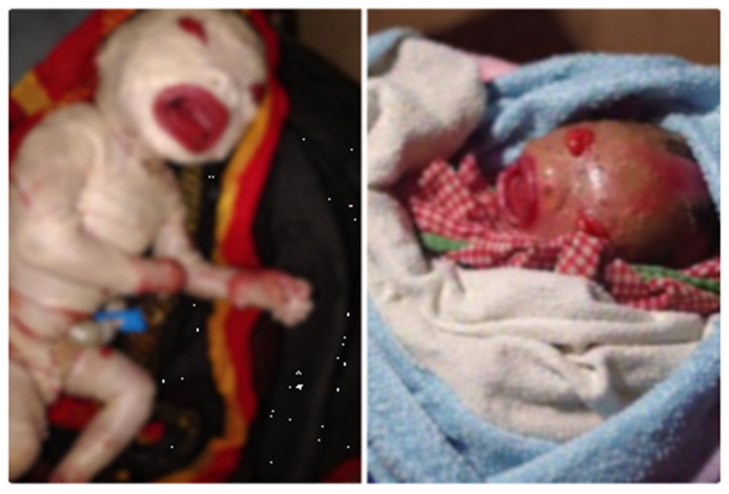 হার্লেকুইন ইকথিওসিস বিরল চর্মরোগ নিয়ে বরখলায় জন্ম নবজাতকের — কী এই রোগ, কতটা বিপজ্জনক?